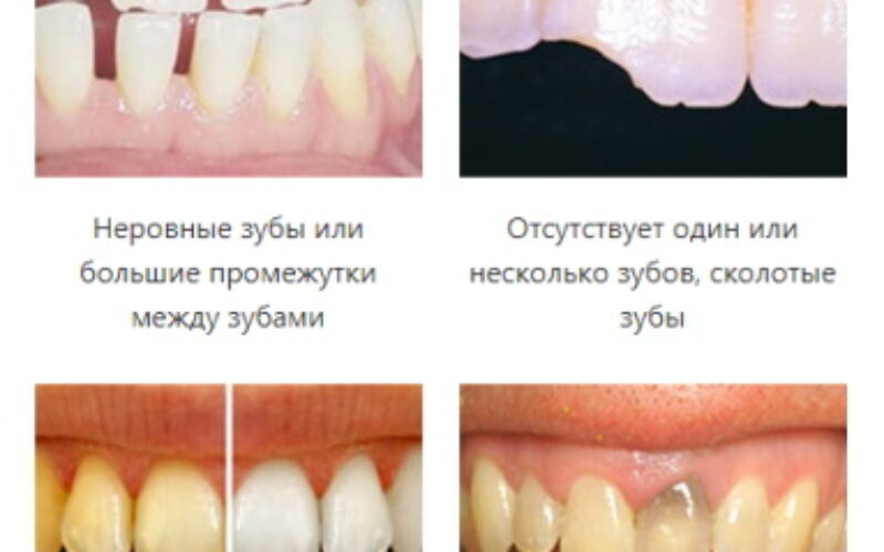 что такое накладка на зуб при протезировании